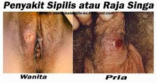 obat sipilis cara mengobati sipilis, obat herbal sipilis, pengobatan sipilis