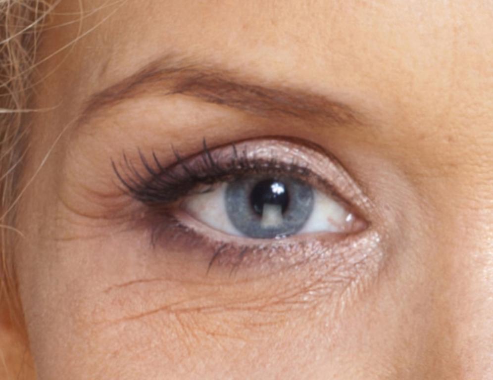 How to Prevent Eye Wrinkles