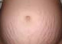 stretch marks stretch marks