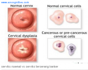 Kanker serviks 2