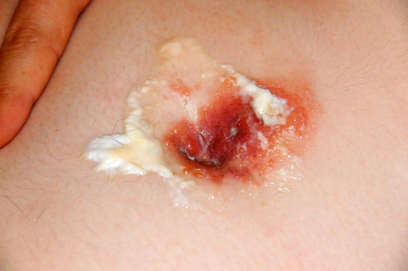 Like this! I was hesitant at first because of all the infections title=