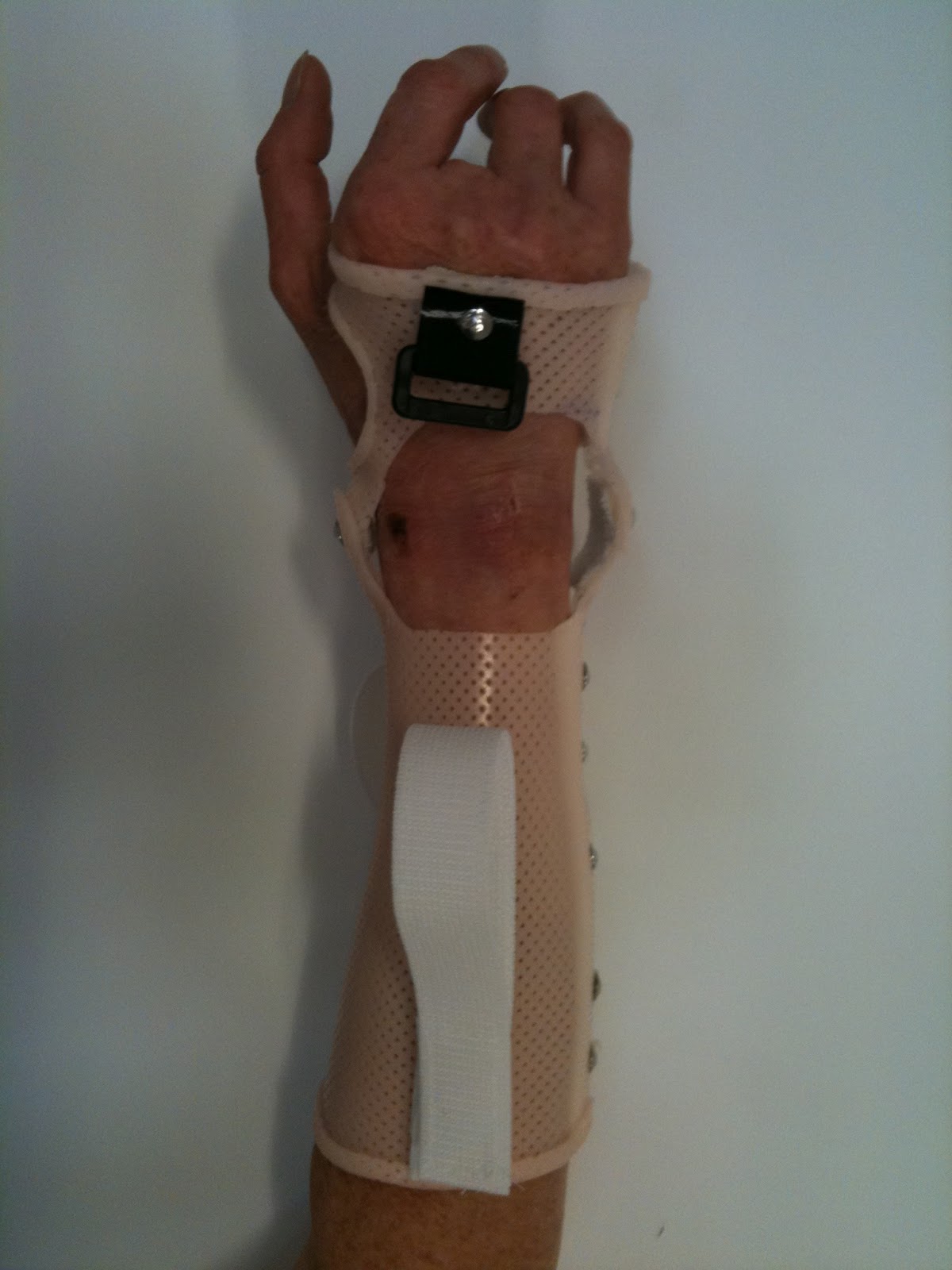 Orthèses sur mesure et appareillage personnalisé main doigts