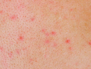 Remedio Para Eliminar El Herpes Remedio Para Eliminar El Herpes