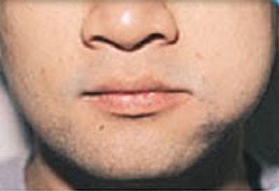 naket azeri girls photo facial swelling tenderness after bridgework