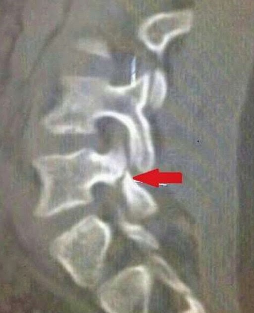 Acute Fracture Pars Fracture-4.bp.blogspot.com