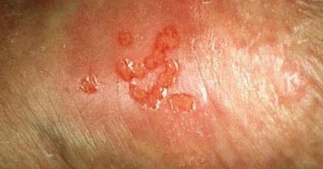 gay sex dads and somns from Giancarlo genital herpes gay outbreaks