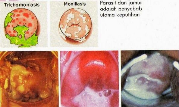 Penyakit Keputihan Pada Wanita Penyakit Keputihan Pada Wanita