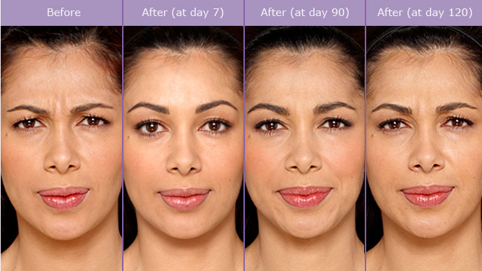 CONFIRA FOTOS DE ANTES E DEPOIS DO BOTOX: