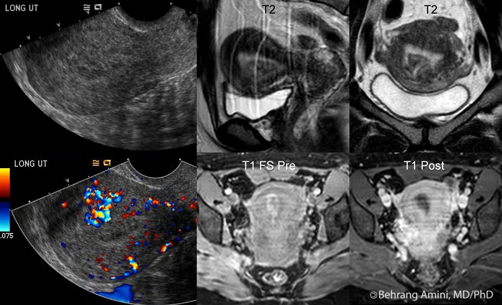 Roentgen Ray Reader Retained Products of Conception