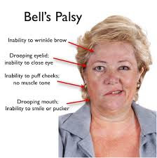 facial palsy definition Facial palsy definition