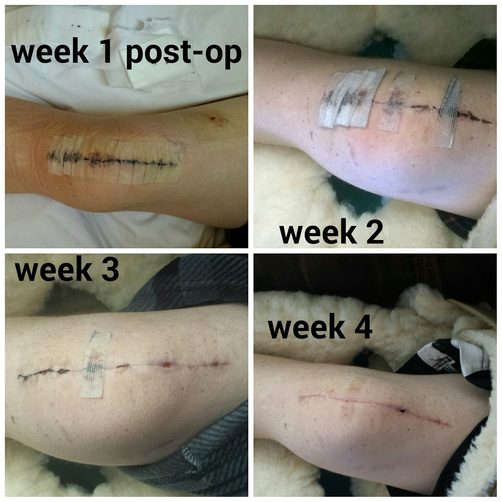 Hello, ReFabulous! B's knee update