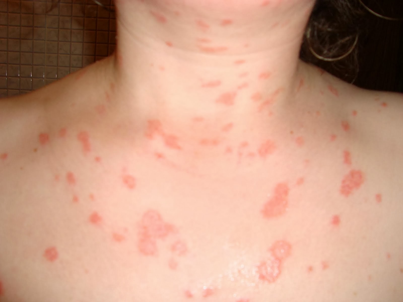 Elena malysheva el sitio oficial sobre la psoriasis