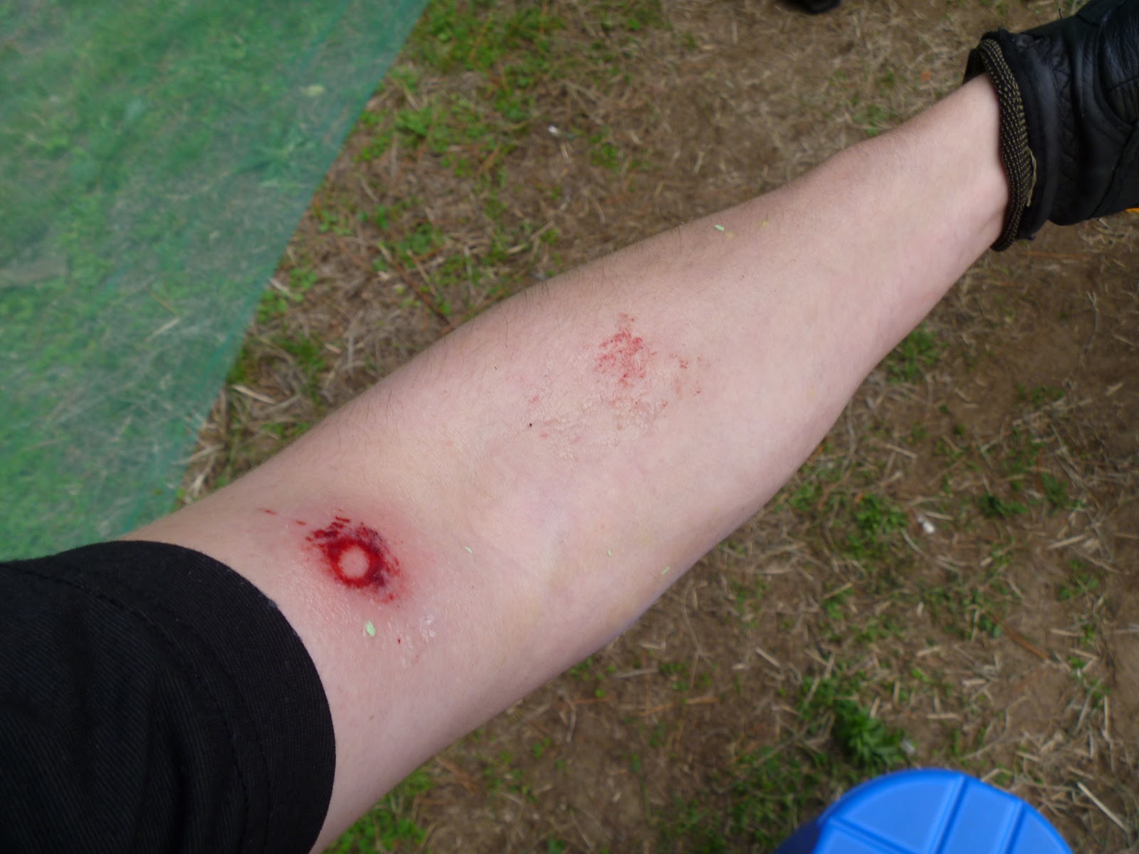 Bad Paintball Welts