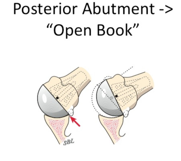 Humeral Head Fracture the register proper (does the humeral head fit nicely in the glenoid-4.bp.blogspot.com