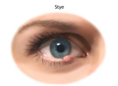 stye eye