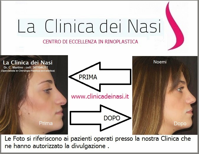 La Clinica Dei Nasi Dr Martino Salerno Chirurgia Plastica Salerno Rinoplastica Noemi La Clinica Dei Nasi Dr C Martino