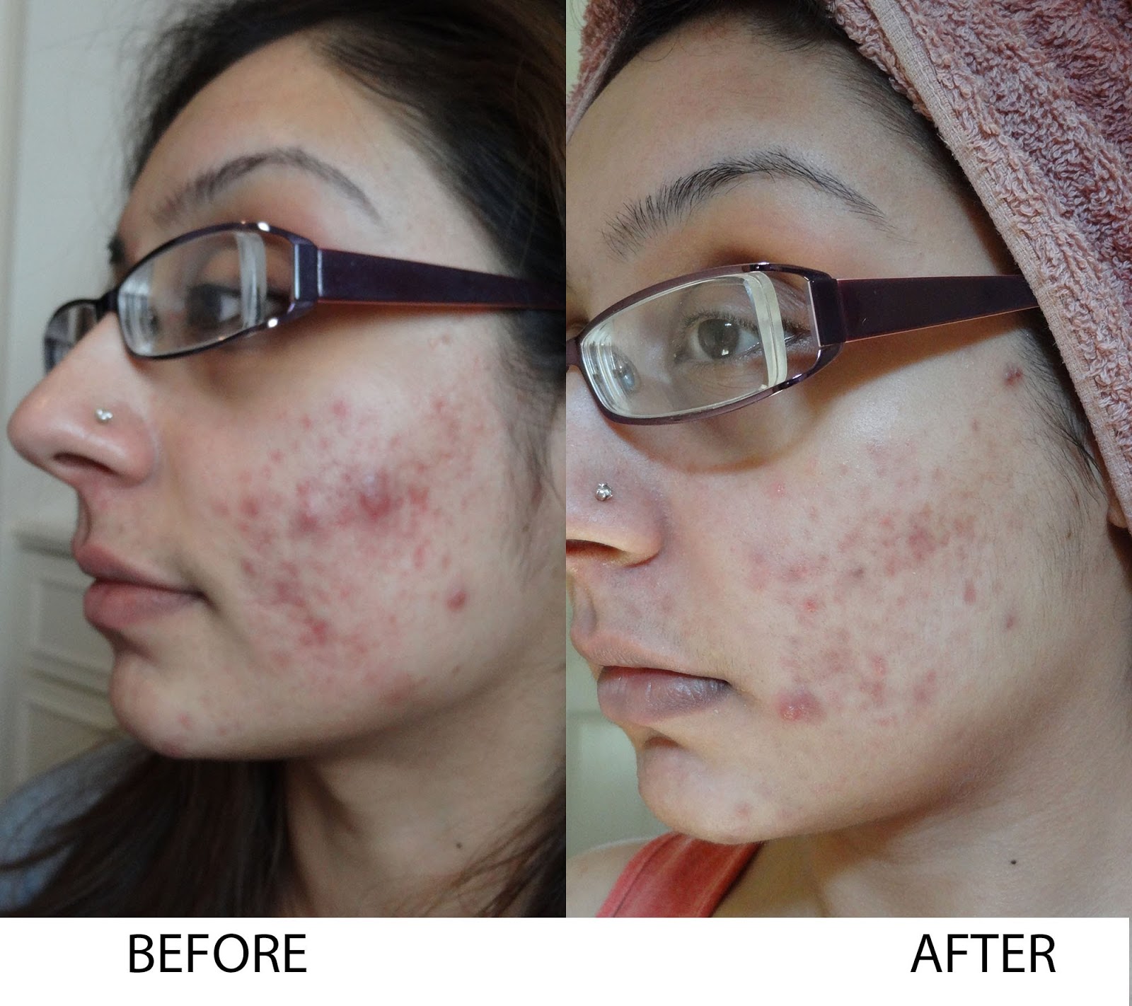 Turmeric for Acne Pimples Treatment and Scars Removal Turmeric for Acne Pimples Treatment and Scars Removal