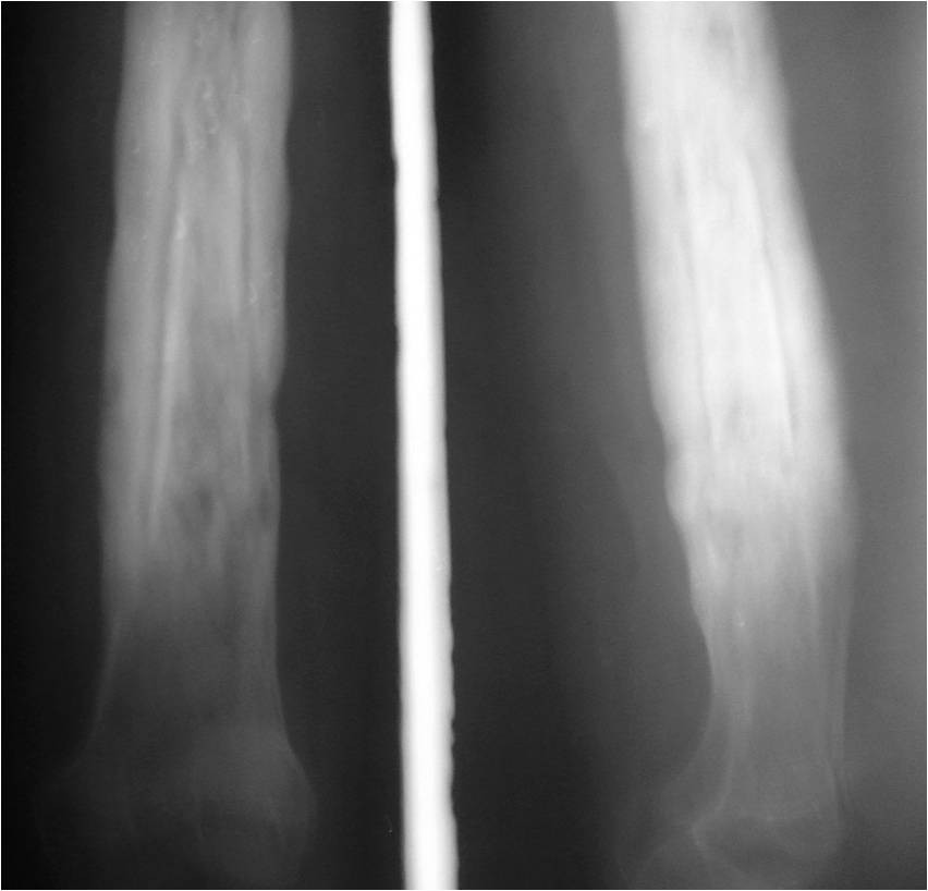 Periosteal reaction for the Radiology Residents Sumer's Radiology Blog