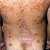 INFORMACION SOBRE EL TRATAMIENTO ANTI-PSORIATICO EN CUBA
