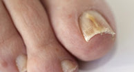 picture of Fungal Nail Infection