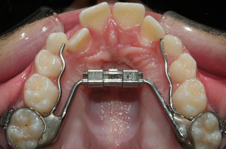 Hiremath Orthodontics Texas Interceptive Orthodontics Explained