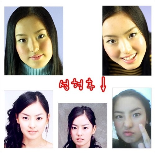 Plastic Surgery Examples: Lee Da Hee before & after / 이다희 성형 수술