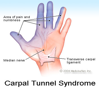 Carpal Tunnel Syndrome : Sakit Otot