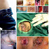 Bebas Wasir Dengan Ambeclear Obat Hemoroid thumbnail