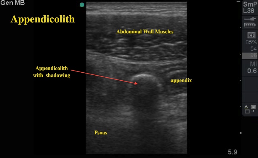 Ultrasound for Appendicitis ~ Ultrasound Cases Info