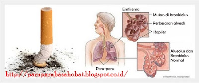 Pengobatan Tradisional Untuk Emfisema Terbaru | Pengobatan Tradisional Paru Paru Basah