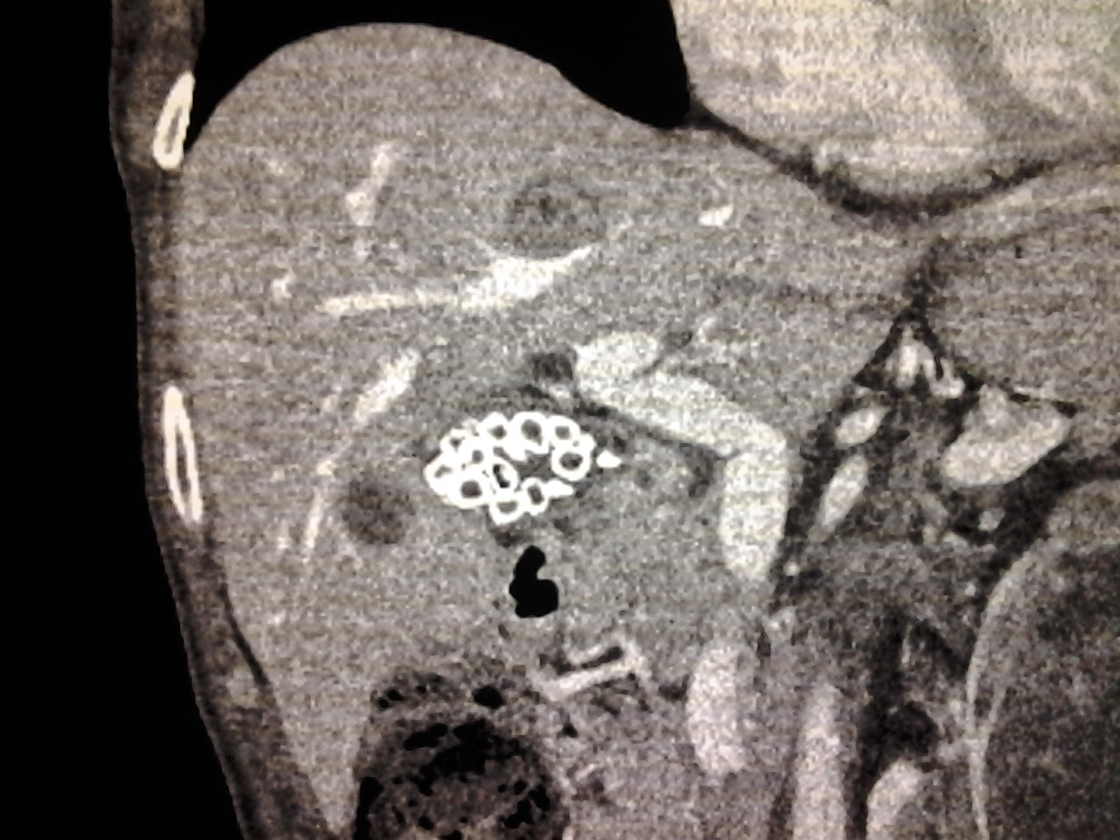 Winding Spiral Case Weekend Review Splenunculi & Peanut Butter