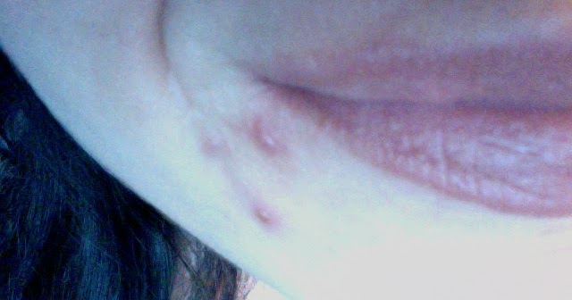 I Thought I Would Have Cystic Acne Forever—Then I Cut Out Dairy photo I Thought I Would Have Cystic Acne Forever—Then I Cut Out Dairy pics