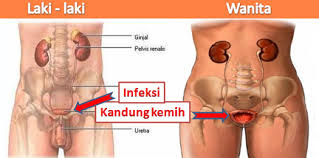 Pengobatan Tradisional Infeksi Saluran Kemih