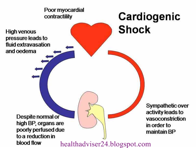 cardiogenic shock due to myocardial