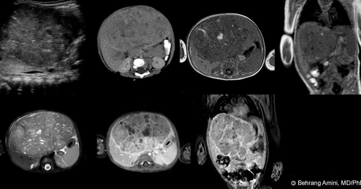 Roentgen Ray Reader Hepatic Lesions in Infants