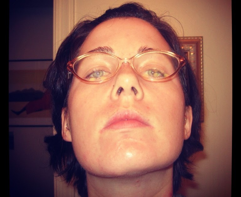 my crooked jaw pre/post