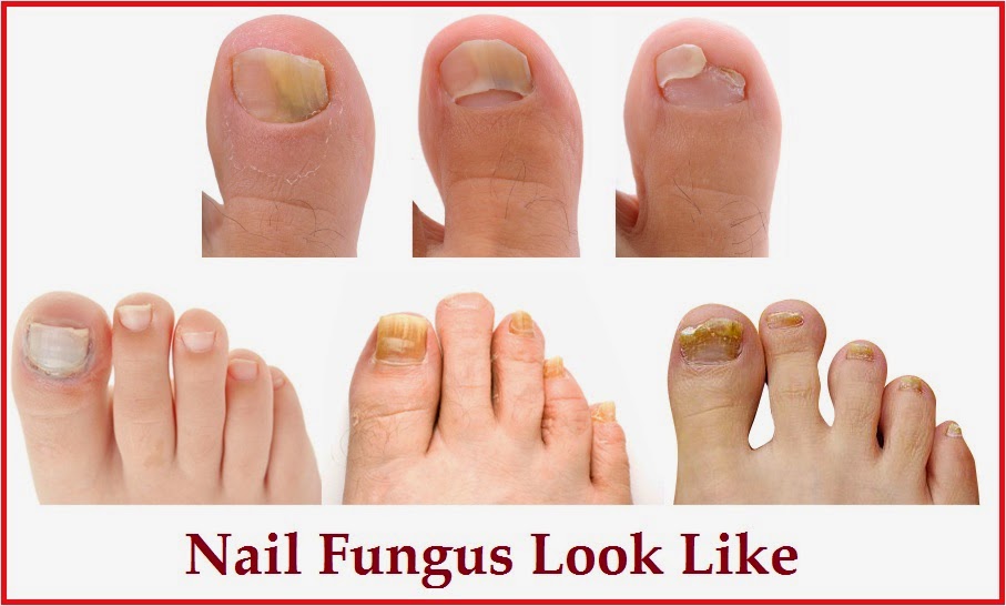 oral lamisil for fingernail fungus