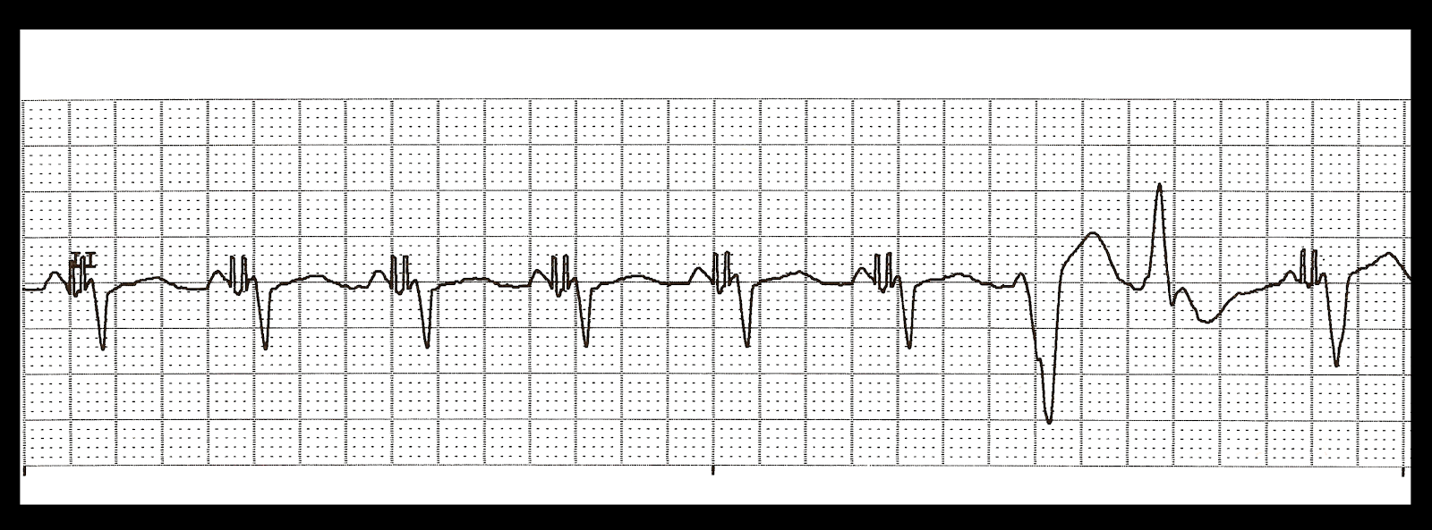 type ii atrial flutter icd 10 type ii atrial flutter icd 10