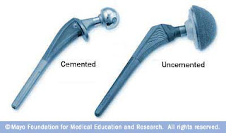 affordable hip replacement abroad best hip replacement hospitals