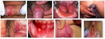 Cara Yang Cepat Sembuh Dari Klamidia Dengan Obat Herbal Cara Yang Cepat Sembuh Dari Klamidia Dengan Obat Herbal