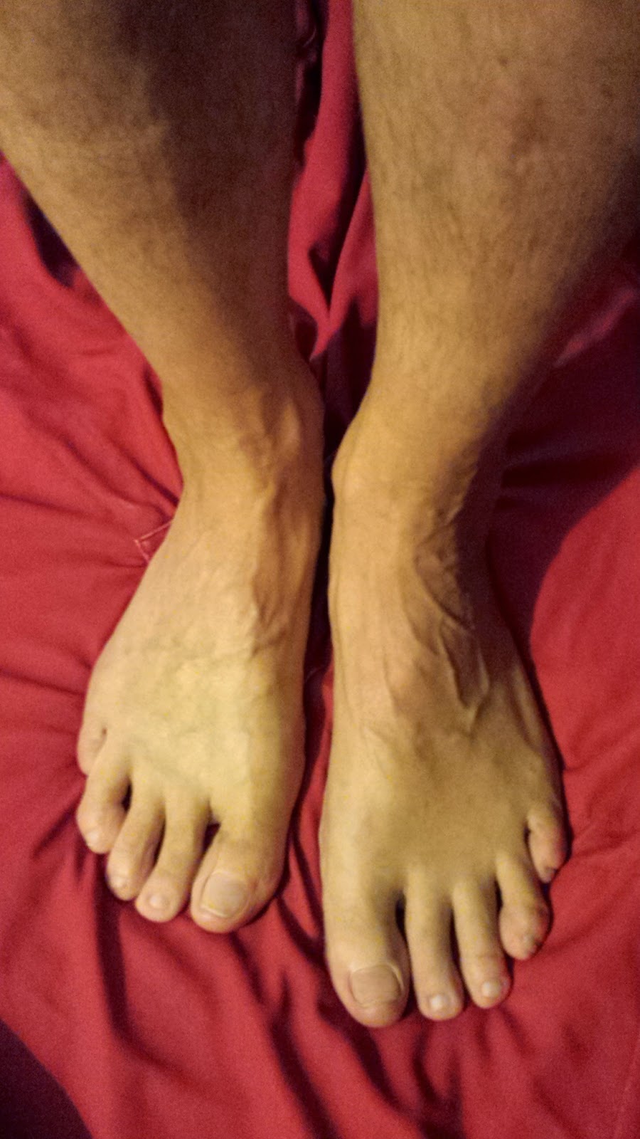 Healing Liver Cirrhosis Look at Jake's Feet NO MORE SWELLING / EDEMA