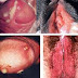 Penis Keluar Cairan Nanah, Apakah Gonore? thumbnail