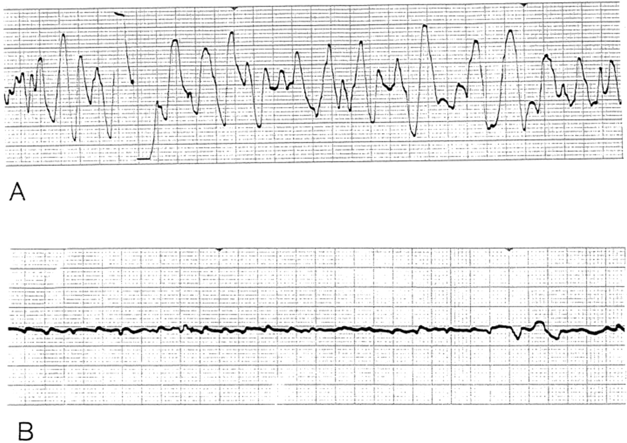 FIREFIGHTER/PARAMEDIC STORIES Heart Rhythms Part 4 Ventricular Rhythms
