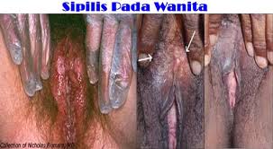 sipilis obatsipilis-tradisional.blogspot.com