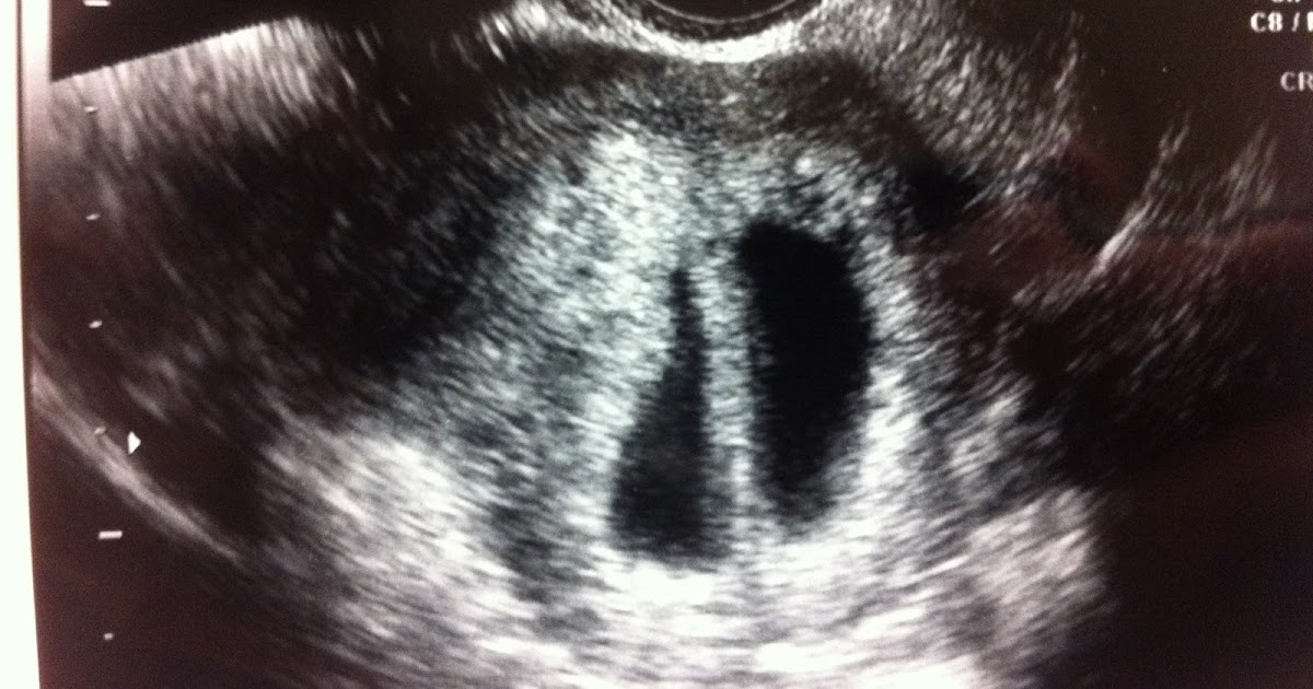 Twin Pregnancy Our first ultrasound