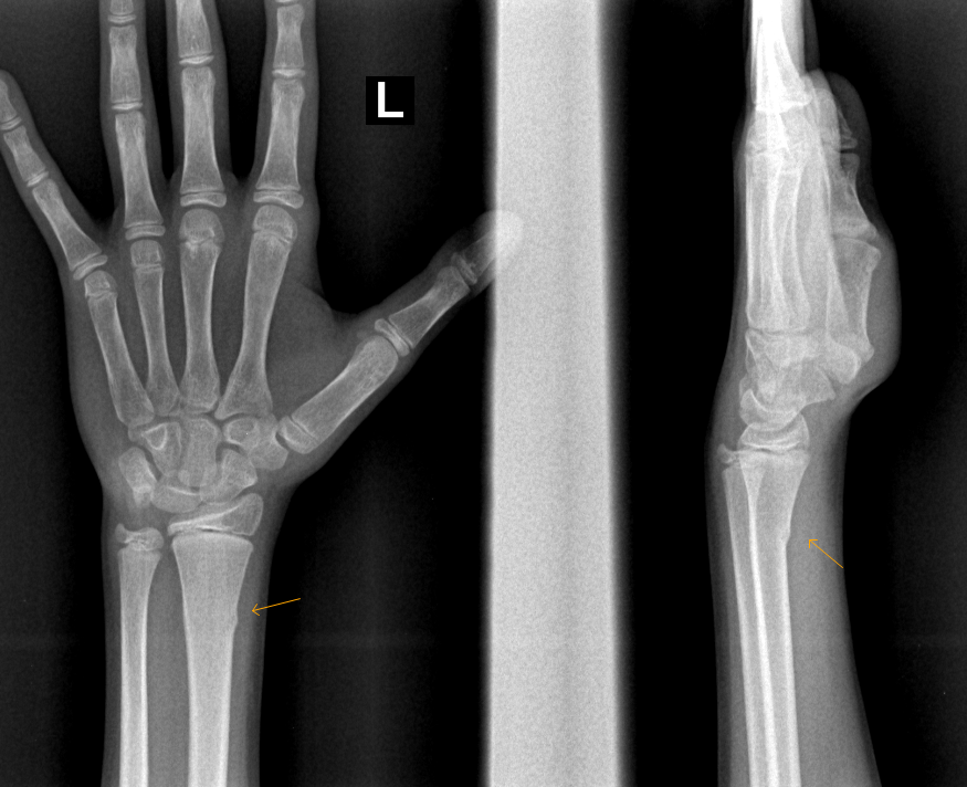 distal radius torus fracture treatment