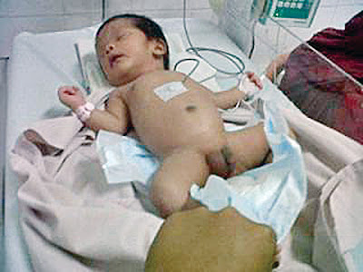 RSUP H Adam Malik Medan kedatangan seorang bayi berkelamin ganda (Hemoprodit). Kini bayi yang bernama Dafa Dafira sedang menjalani proses pemeriksaan di rumah sakit milik pemerintah ini, Kamis (11/4) pagi.