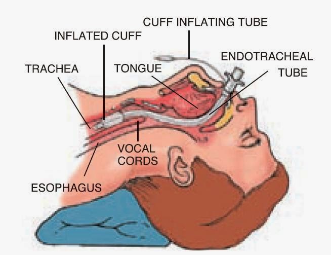 Endotracheal Tube (ETT) Nursing