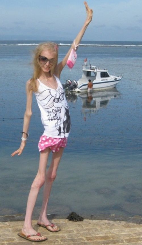 ΣΟΚ:Είναι 20 ετών και ζυγίζει 20 κιλά!! Ksenia Bubenko 1 ΣΟΚ:Είναι 20 ετών και ζυγίζει 20 κιλά!!