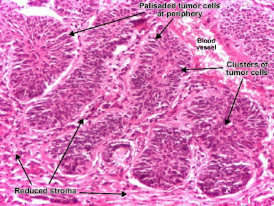 Histology and Explanation of Basal cell carcinoma